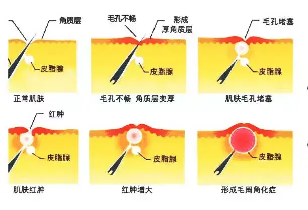 手臂皮肤粗糙怎么办_鸡皮肤形成原因