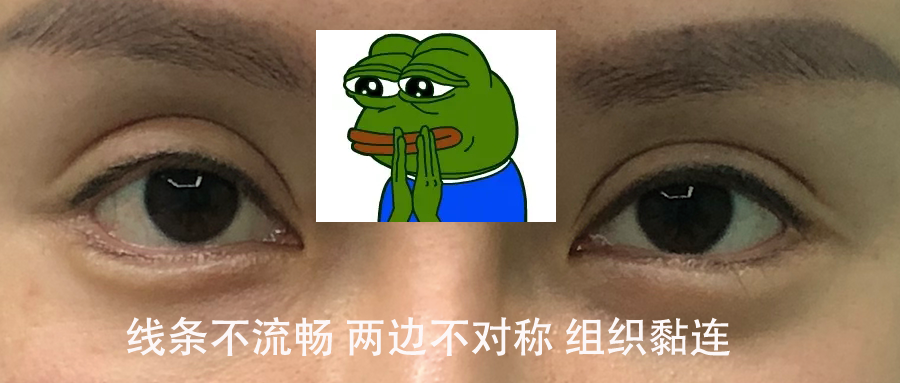 做个双眼皮多少钱_双眼皮失败案例