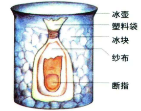 手外伤的分类有哪些？一旦手外伤怎么办？